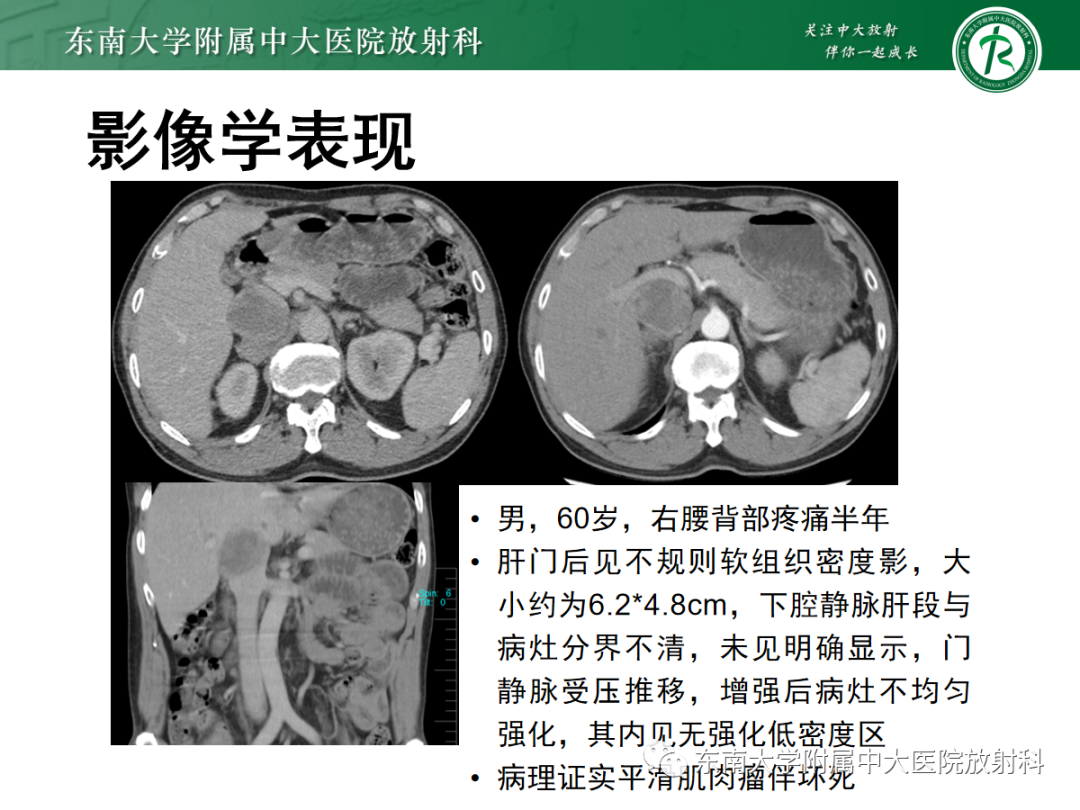 影像PPT - 【PPT】腹膜后脂肪肉瘤-28