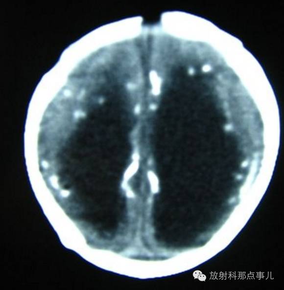 影像PPT - 什么是TORCH综合征?CT如何诊断?-3 影像PPT - 什么是TORCH综合征?CT如何诊断?-3
