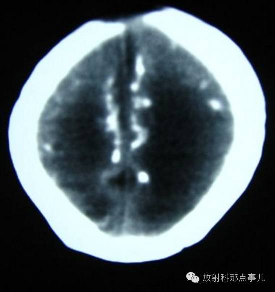 影像PPT - 什么是TORCH综合征?CT如何诊断?-4 影像PPT - 什么是TORCH综合征?CT如何诊断?-4