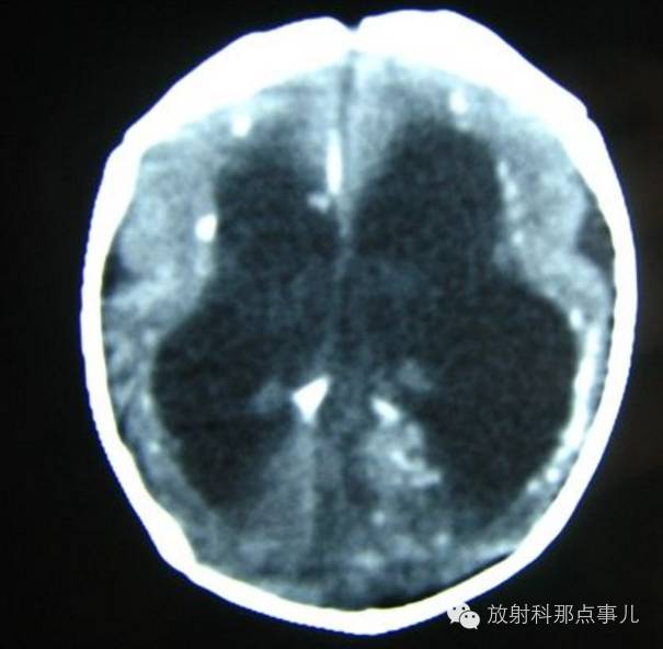 影像PPT - 什么是TORCH综合征?CT如何诊断?-2 影像PPT - 什么是TORCH综合征?CT如何诊断?-2