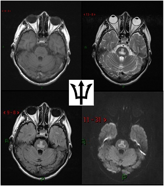 影像PPT - 14 个病例,带你搞定慢性酒精中毒性脑病影像学表现-4 影像PPT - 14 个病例,带你搞定慢性酒精中毒性脑病影像学表现-4