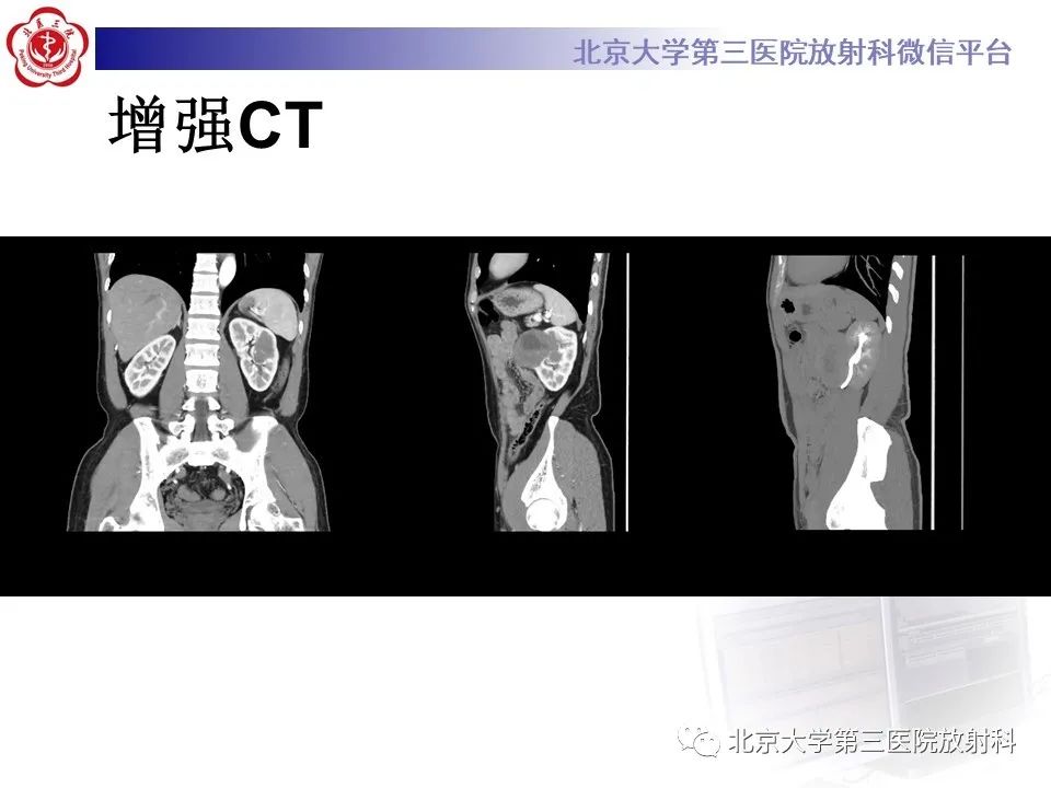 影像PPT - 【PPT】肾脏平滑肌瘤-5