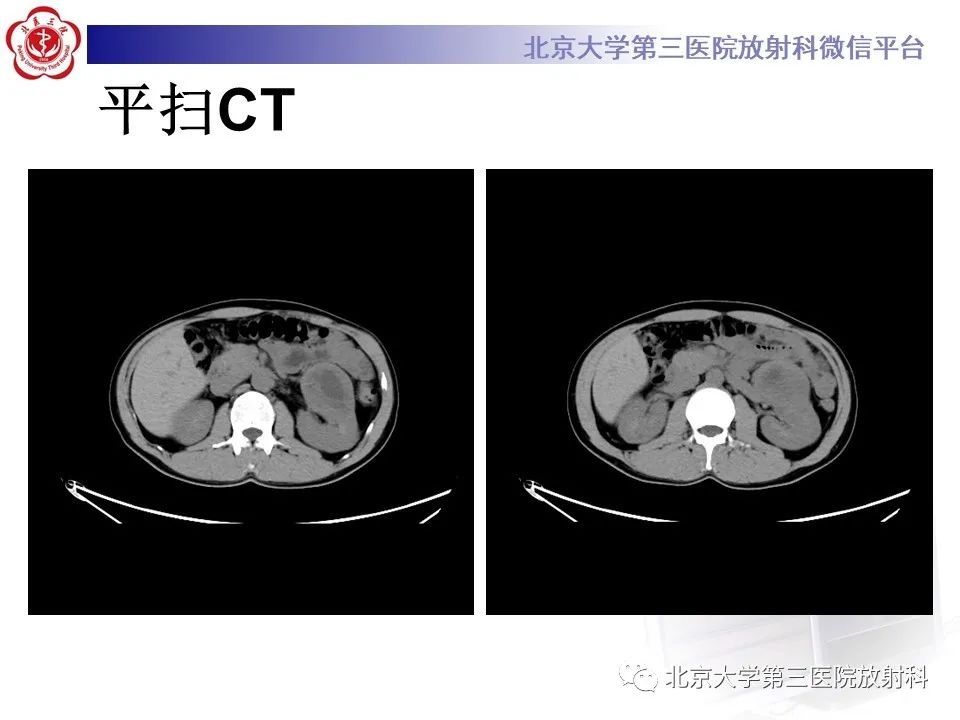 影像PPT - 【PPT】肾脏平滑肌瘤-3