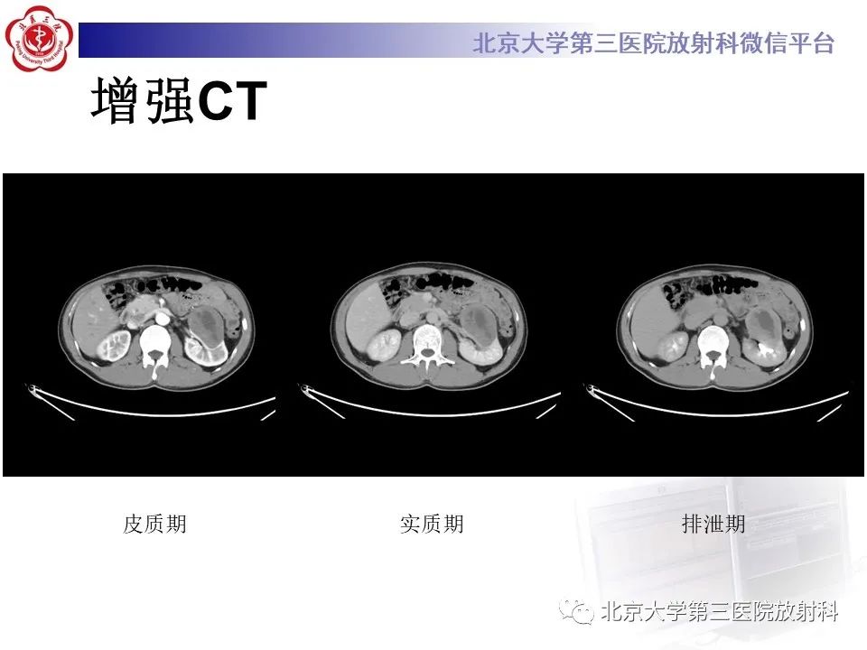 影像PPT - 【PPT】肾脏平滑肌瘤-4
