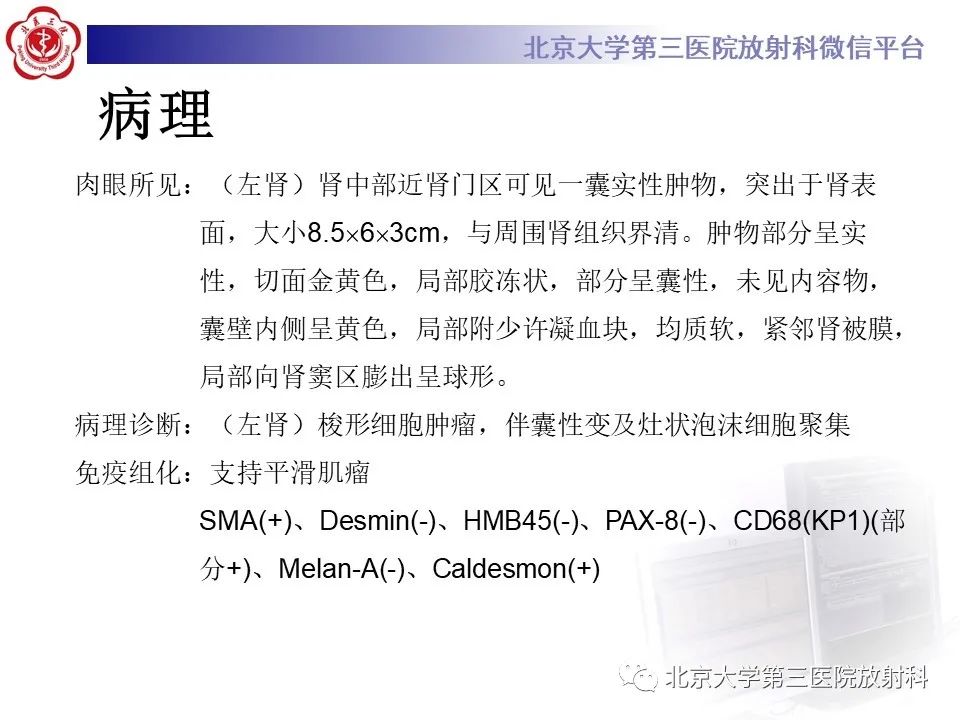 影像PPT - 【PPT】肾脏平滑肌瘤-8