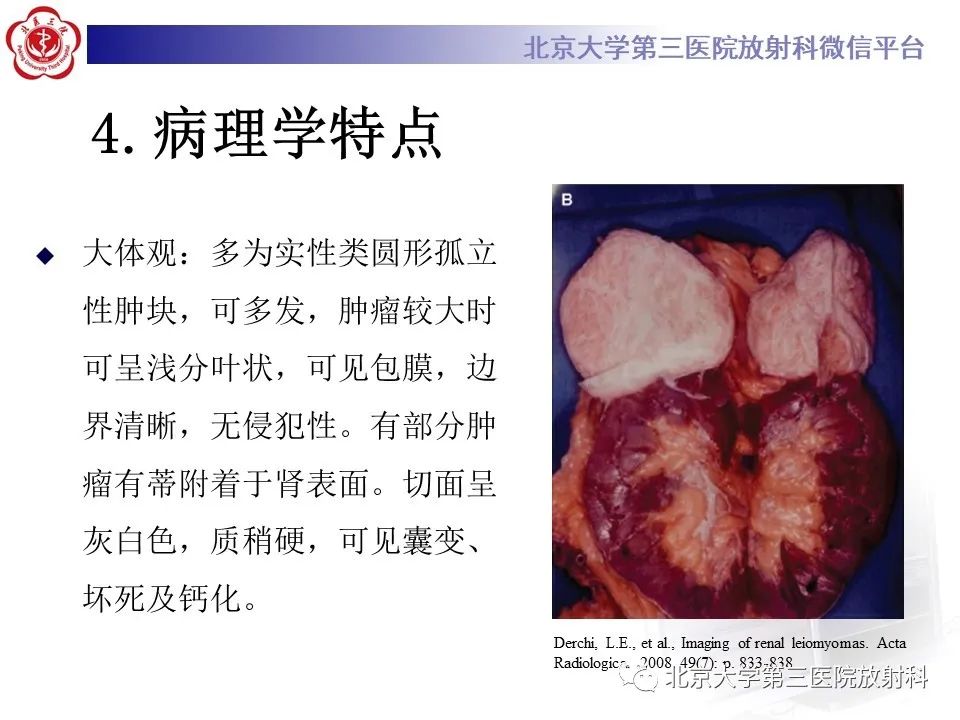 影像PPT - 【PPT】肾脏平滑肌瘤-13