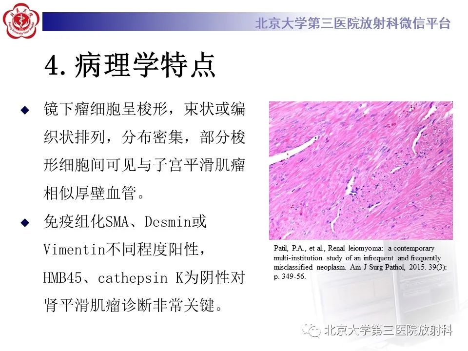 影像PPT - 【PPT】肾脏平滑肌瘤-14