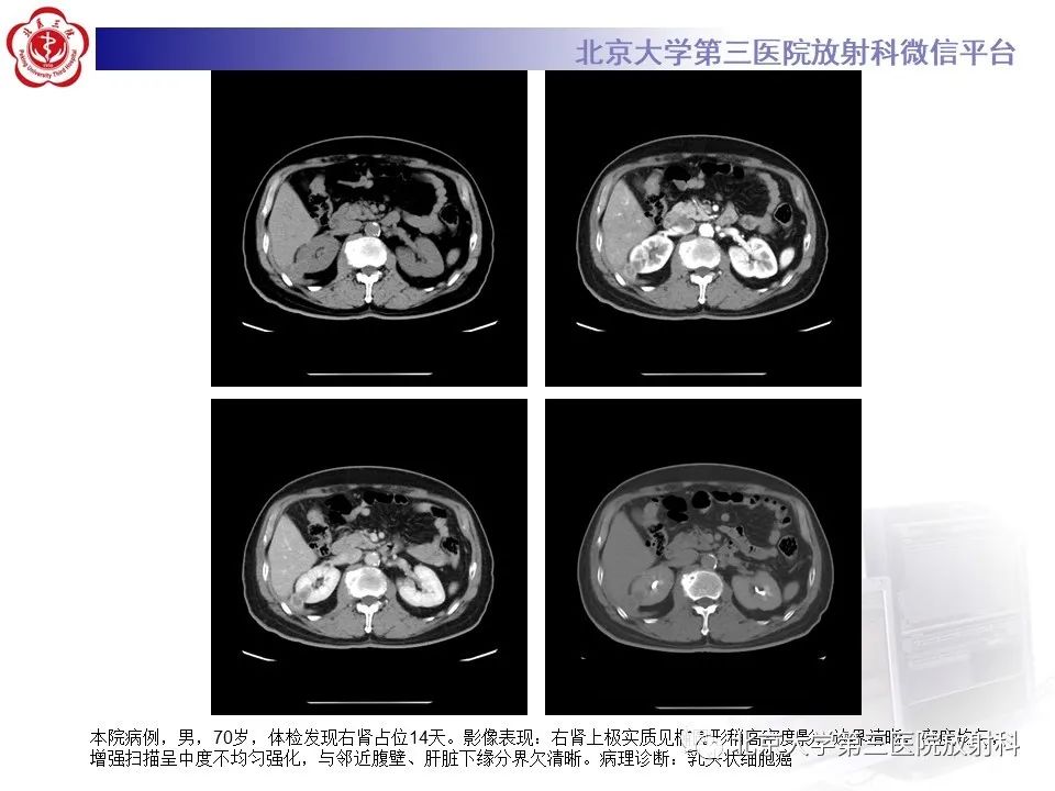影像PPT - 【PPT】肾脏平滑肌瘤-20