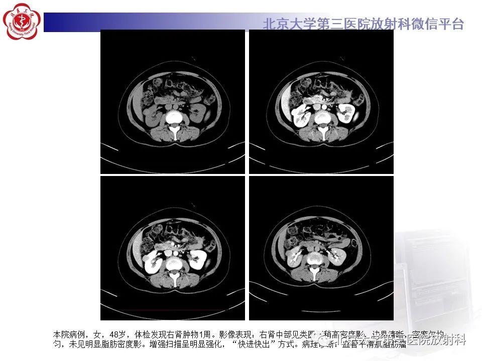 影像PPT - 【PPT】肾脏平滑肌瘤-23