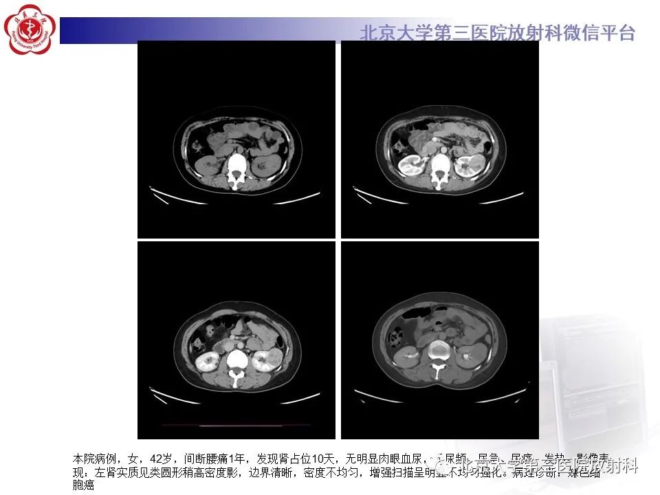 影像PPT - 【PPT】肾脏平滑肌瘤-21