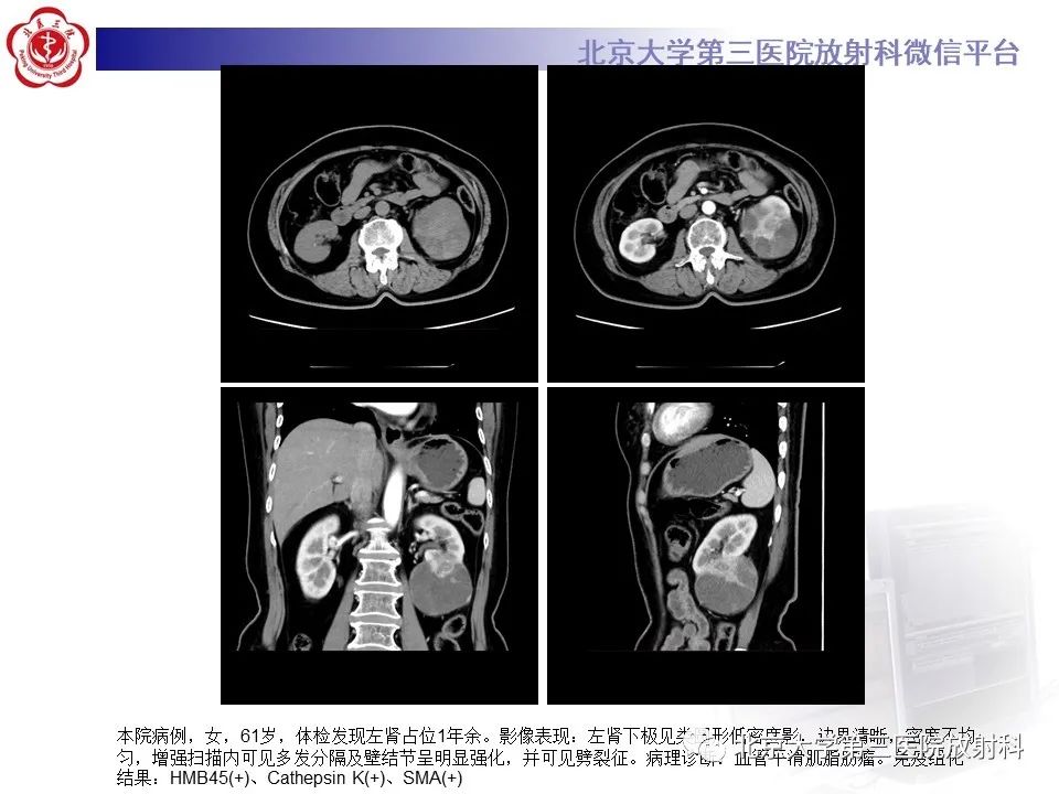 影像PPT - 【PPT】肾脏平滑肌瘤-24