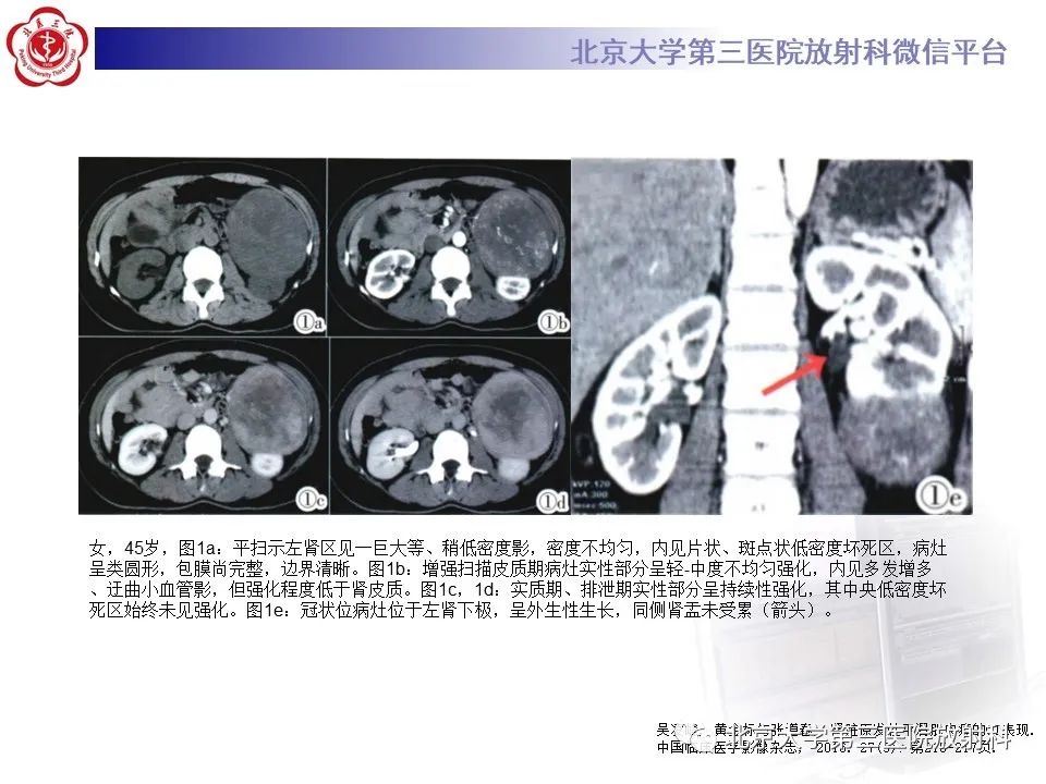 影像PPT - 【PPT】肾脏平滑肌瘤-26