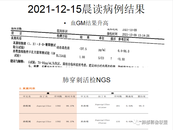 影像PPT - 【病例】白血病合并曲霉菌感染-35 影像PPT - 【病例】白血病合并曲霉菌感染-35