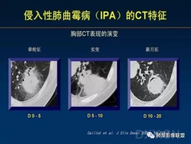 影像PPT - 白血病肺部病变读书笔记及实战-24 影像PPT - 白血病肺部病变读书笔记及实战-24