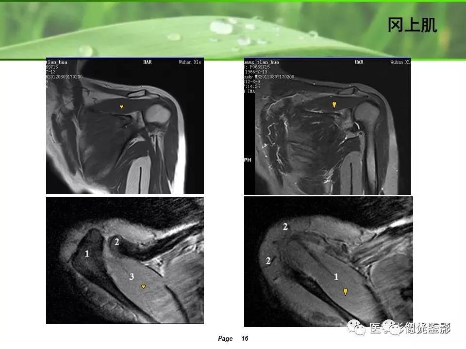 影像PPT - 【PPT】肩关节MRI-14 影像PPT - 【PPT】肩关节MRI-14