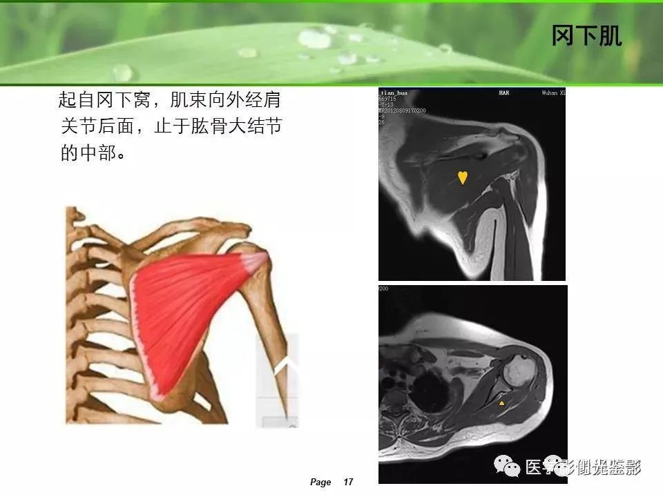影像PPT - 【PPT】肩关节MRI-15 影像PPT - 【PPT】肩关节MRI-15