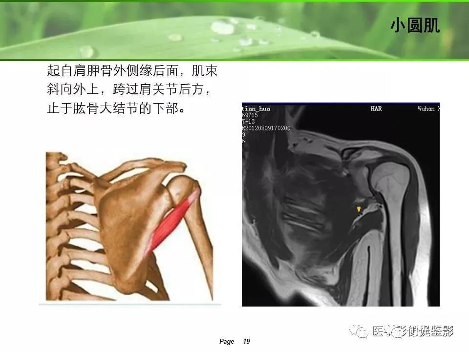 影像PPT - 【PPT】肩关节MRI-17 影像PPT - 【PPT】肩关节MRI-17