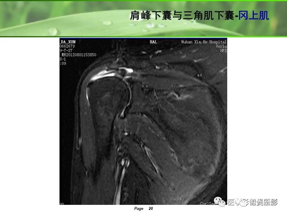 影像PPT - 【PPT】肩关节MRI-24 影像PPT - 【PPT】肩关节MRI-24