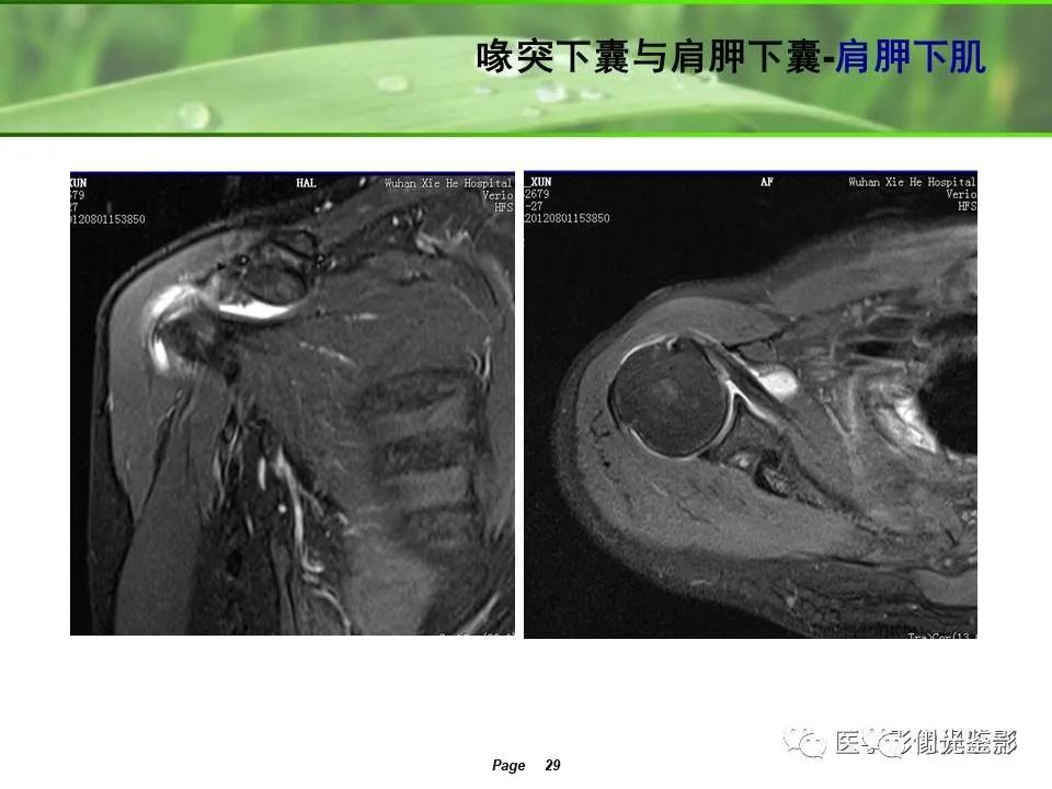 影像PPT - 【PPT】肩关节MRI-25 影像PPT - 【PPT】肩关节MRI-25
