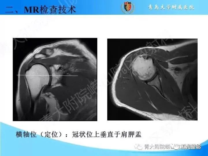 影像PPT - 【PPT】肩关节MRI-27 影像PPT - 【PPT】肩关节MRI-27