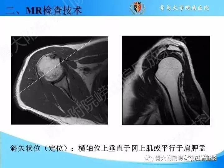 影像PPT - 【PPT】肩关节MRI-29 影像PPT - 【PPT】肩关节MRI-29
