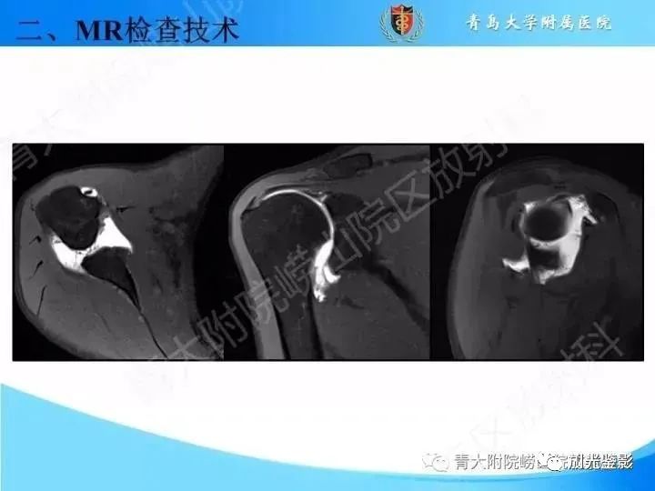 影像PPT - 【PPT】肩关节MRI-31 影像PPT - 【PPT】肩关节MRI-31