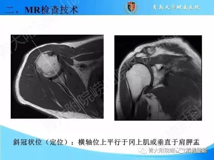 影像PPT - 【PPT】肩关节MRI-28 影像PPT - 【PPT】肩关节MRI-28