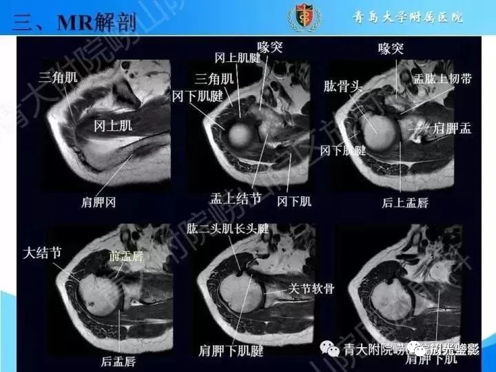 影像PPT - 【PPT】肩关节MRI-32 影像PPT - 【PPT】肩关节MRI-32