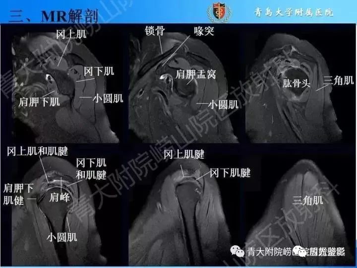影像PPT - 【PPT】肩关节MRI-34 影像PPT - 【PPT】肩关节MRI-34