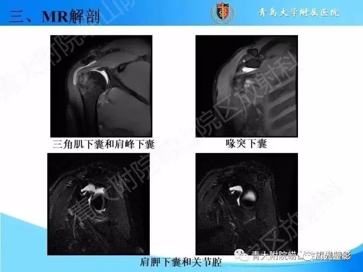 影像PPT - 【PPT】肩关节MRI-35 影像PPT - 【PPT】肩关节MRI-35