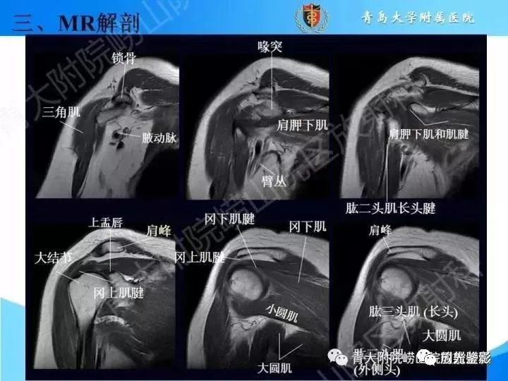 影像PPT - 【PPT】肩关节MRI-33 影像PPT - 【PPT】肩关节MRI-33