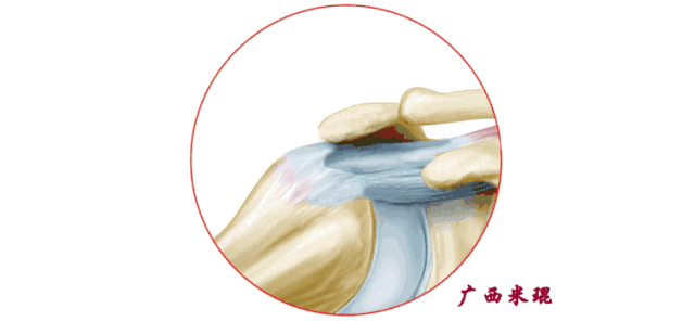 影像PPT - 【PPT】肩关节MRI-55 影像PPT - 【PPT】肩关节MRI-55