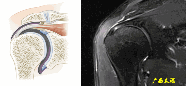 影像PPT - 【PPT】肩关节MRI-60 影像PPT - 【PPT】肩关节MRI-60