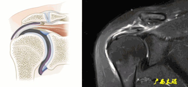 影像PPT - 【PPT】肩关节MRI-62 影像PPT - 【PPT】肩关节MRI-62