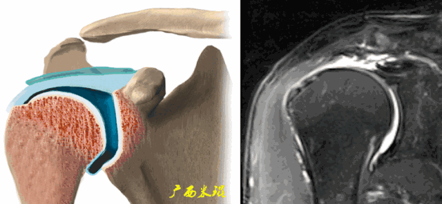 影像PPT - 【PPT】肩关节MRI-67 影像PPT - 【PPT】肩关节MRI-67