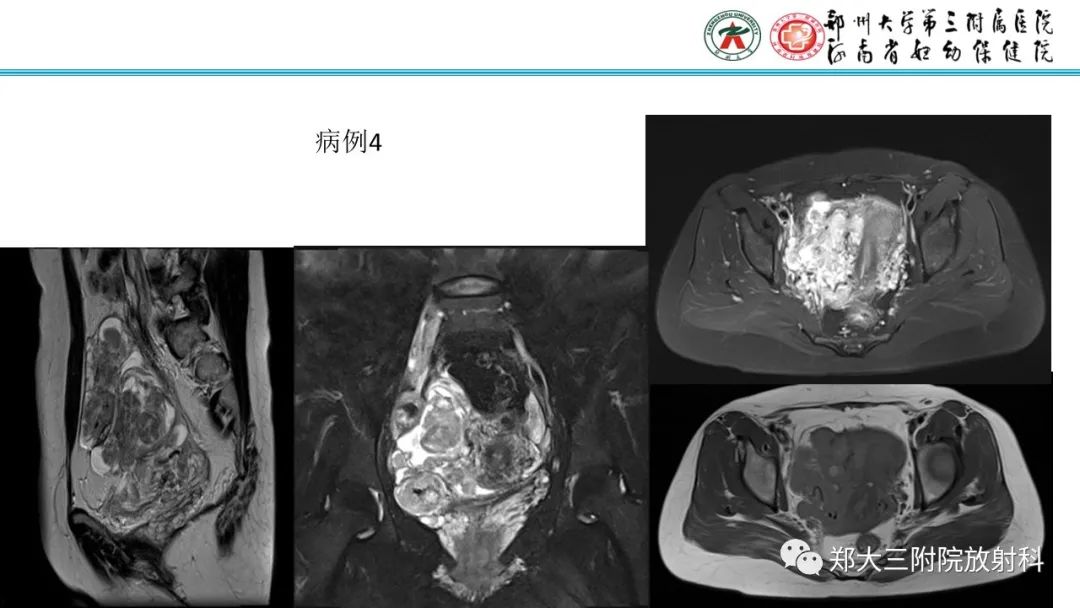 影像PPT - 【PPT】静脉内平滑肌瘤病的影像学诊断-5