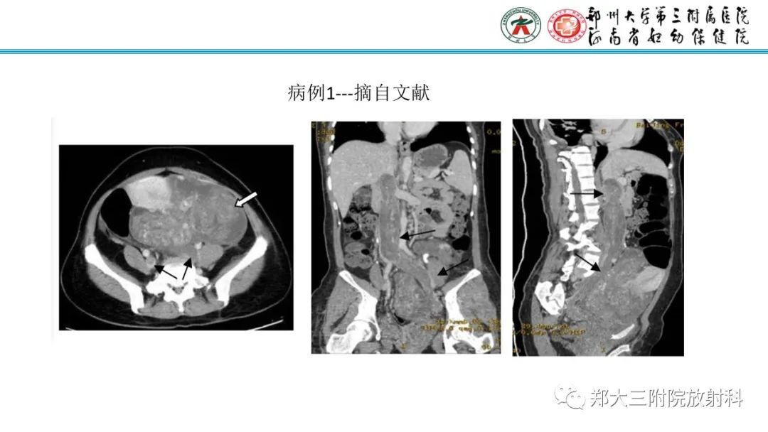 影像PPT - 【PPT】静脉内平滑肌瘤病的影像学诊断-2
