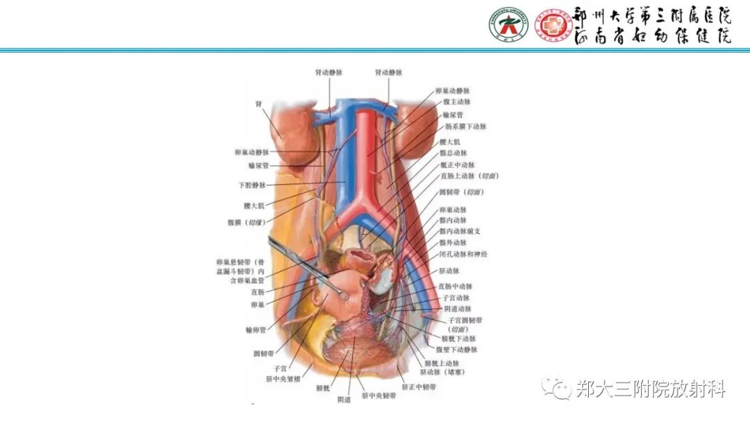 影像PPT - 【PPT】静脉内平滑肌瘤病的影像学诊断-11