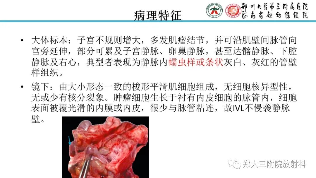 影像PPT - 【PPT】静脉内平滑肌瘤病的影像学诊断-15
