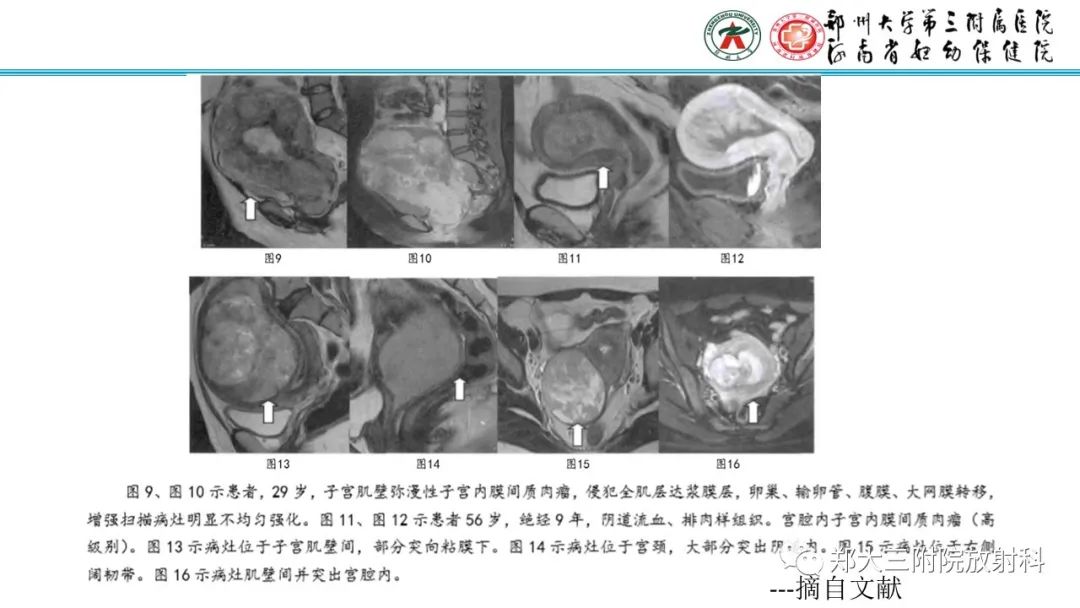 影像PPT - 【PPT】静脉内平滑肌瘤病的影像学诊断-23