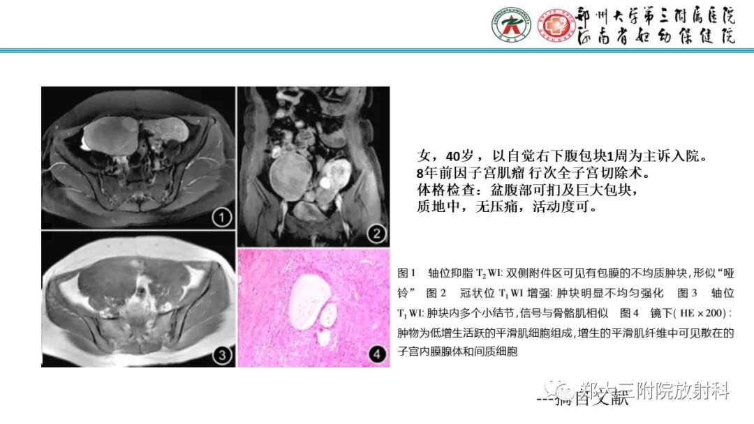 影像PPT - 【PPT】静脉内平滑肌瘤病的影像学诊断-25