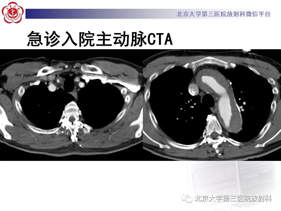 影像PPT - 【PPT】1例STANFORD A型主动脉壁内血肿转化夹层手术治影像学表现-4