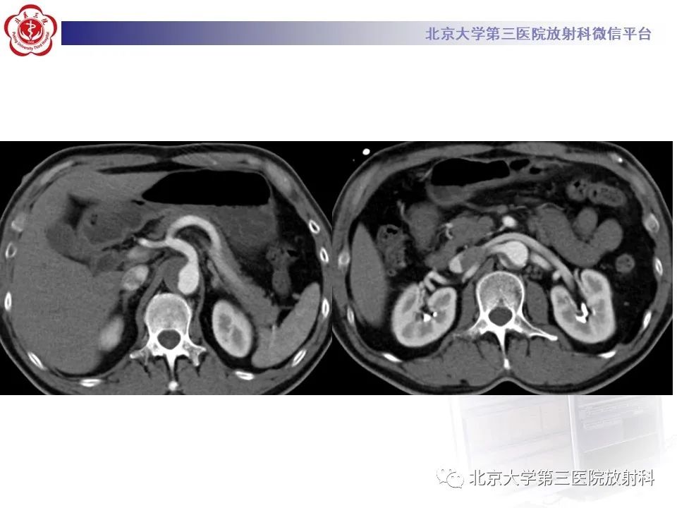 影像PPT - 【PPT】1例STANFORD A型主动脉壁内血肿转化夹层手术治影像学表现-6