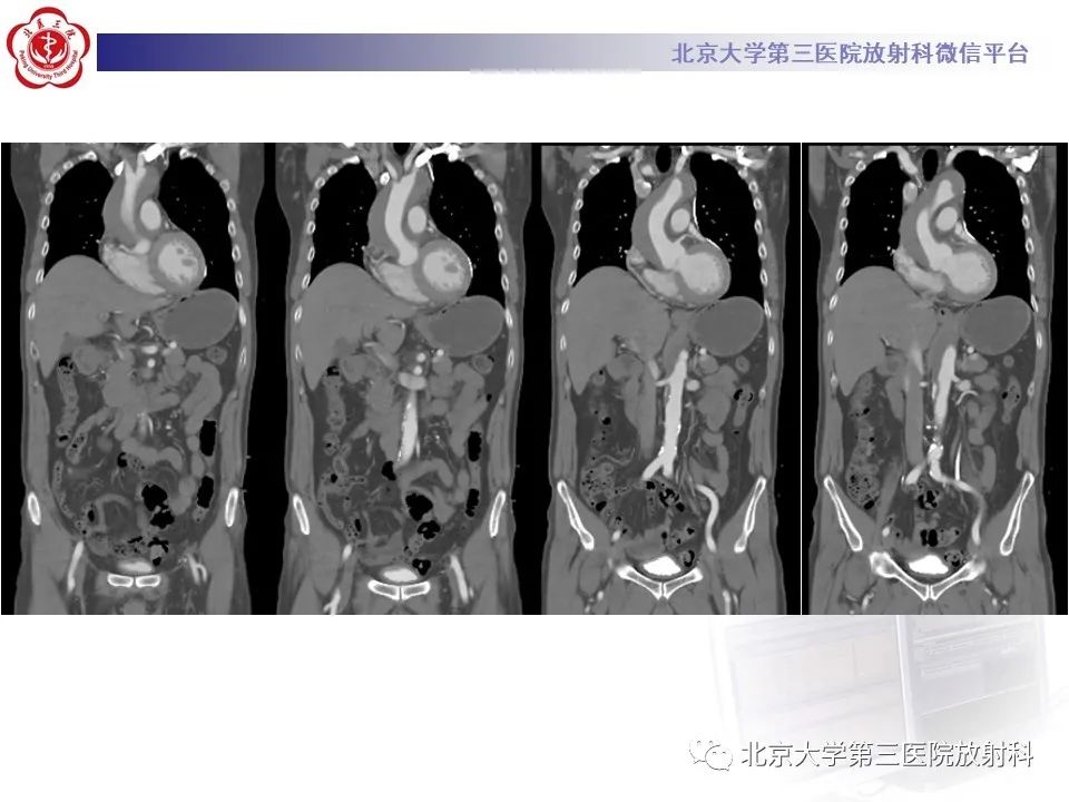 影像PPT - 【PPT】1例STANFORD A型主动脉壁内血肿转化夹层手术治影像学表现-7