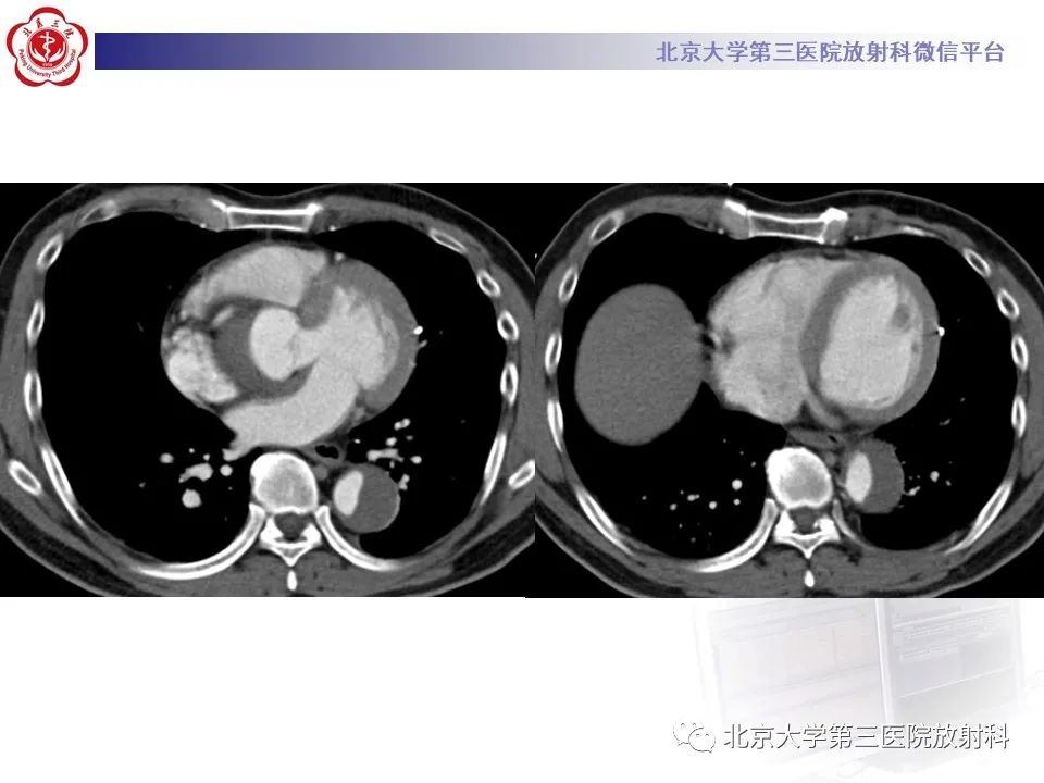 影像PPT - 【PPT】1例STANFORD A型主动脉壁内血肿转化夹层手术治影像学表现-5