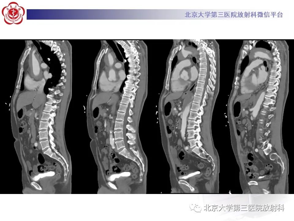 影像PPT - 【PPT】1例STANFORD A型主动脉壁内血肿转化夹层手术治影像学表现-8