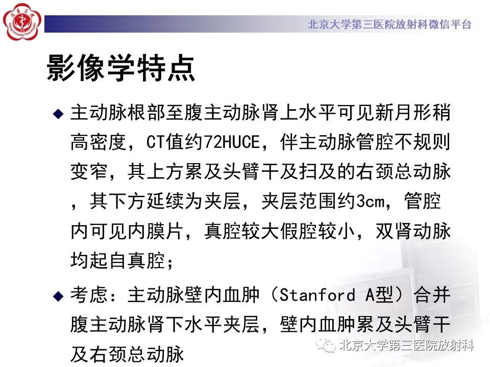 影像PPT - 【PPT】1例STANFORD A型主动脉壁内血肿转化夹层手术治影像学表现-9