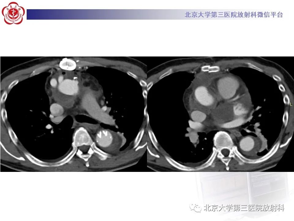 影像PPT - 【PPT】1例STANFORD A型主动脉壁内血肿转化夹层手术治影像学表现-15