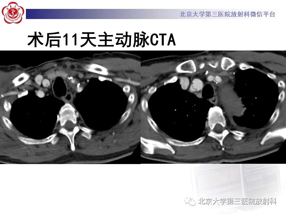 影像PPT - 【PPT】1例STANFORD A型主动脉壁内血肿转化夹层手术治影像学表现-13