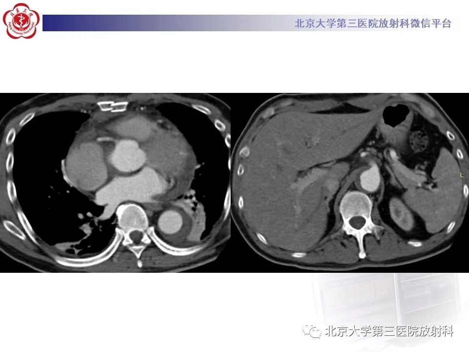影像PPT - 【PPT】1例STANFORD A型主动脉壁内血肿转化夹层手术治影像学表现-16